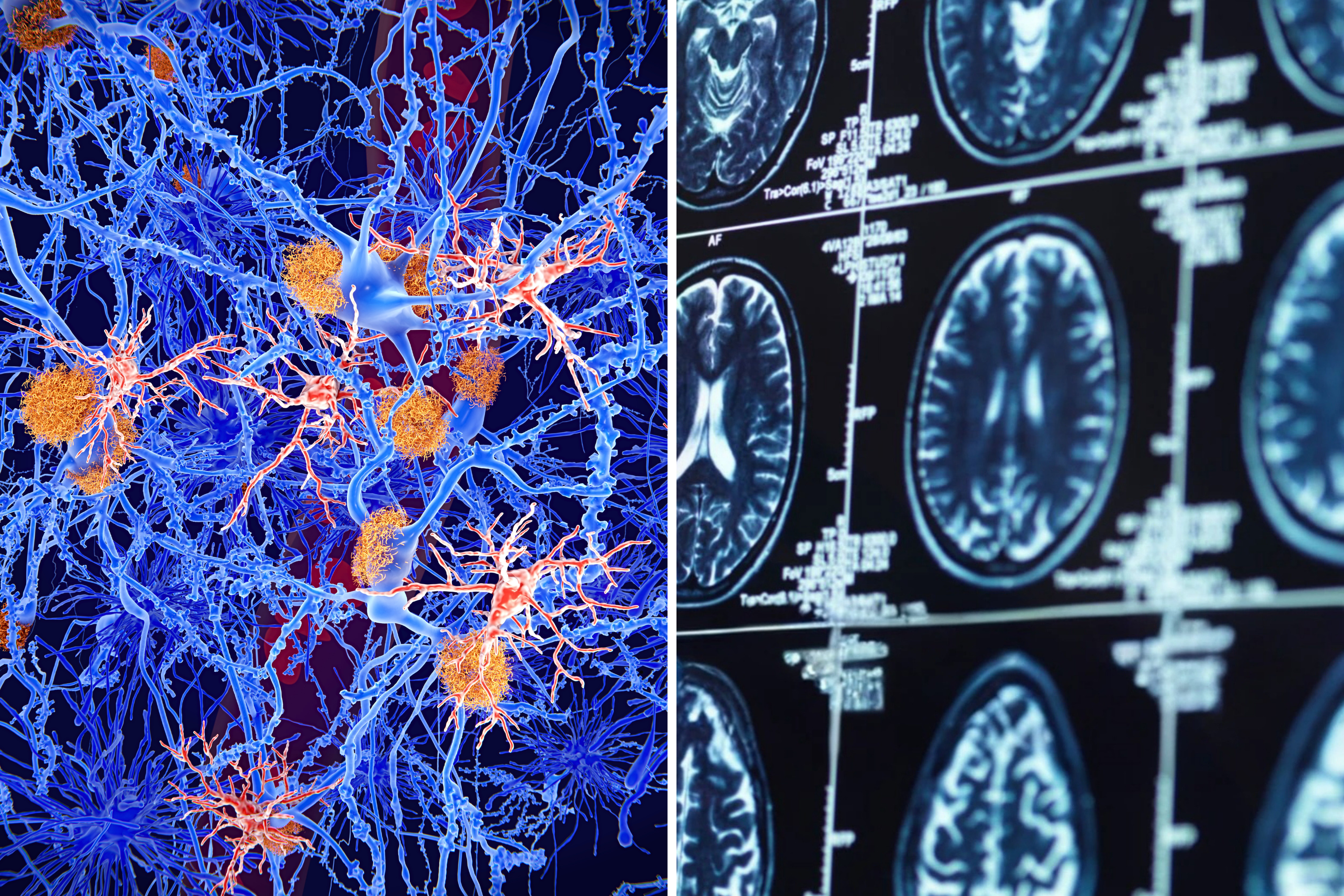 Comparison of healthy vs diseased neurons in Alzheimer's