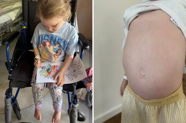 From left: Ayla in a wheelchair and the mass in her abdomen.