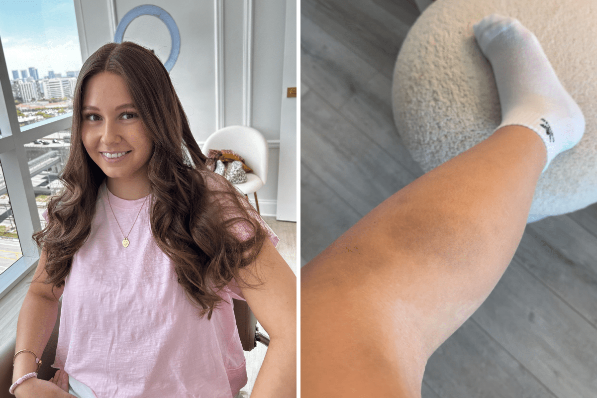 I Thought the Bruising Was From Tennis&mdash;Then Scans Revealed Terrifying Truth
