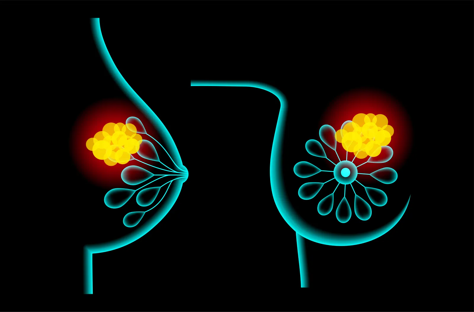 Women With a Negative BRCA Test May Still Face Higher Breast Cancer Risk