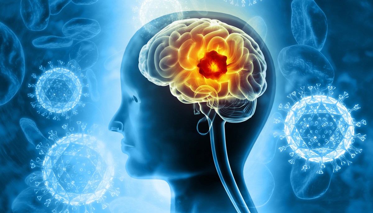 The Deadliest Brain Cancer Has No Cure—a New Approach May Change That