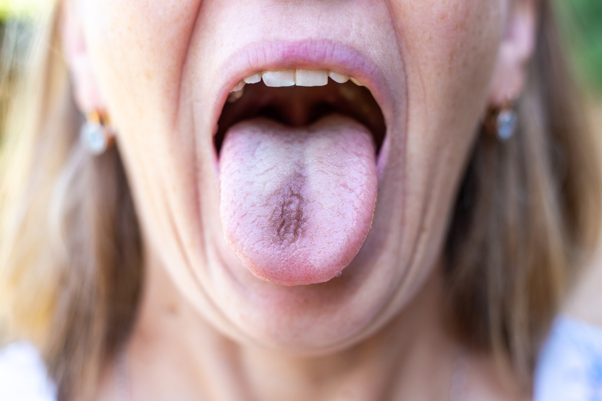 I& 039;m a Hygienist—What Your Tongue Reveals About Your Health I& 039;m a Hygienist—What Your Tongue Reveals About Your Health