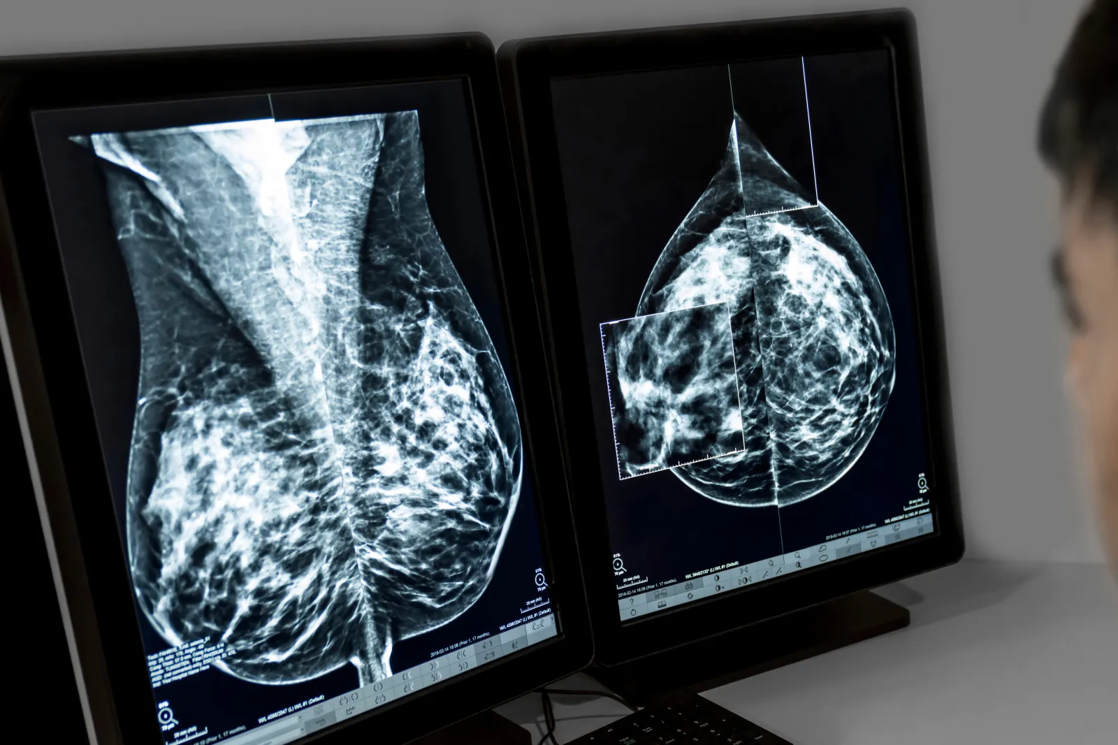 New Breast Cancer Test Spots Hidden Pattern Linked to Survival Chances 