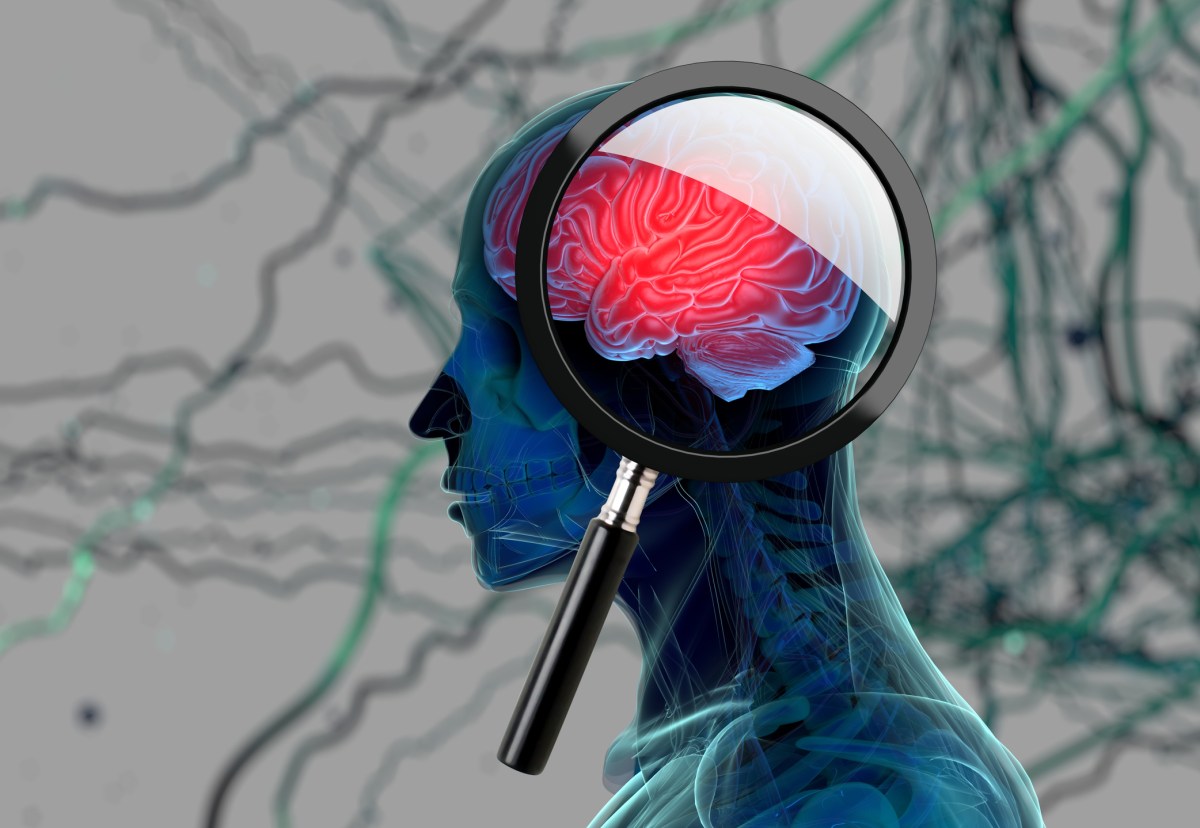 Sleep Test May Help Spot Alzheimer's Early, Study Finds