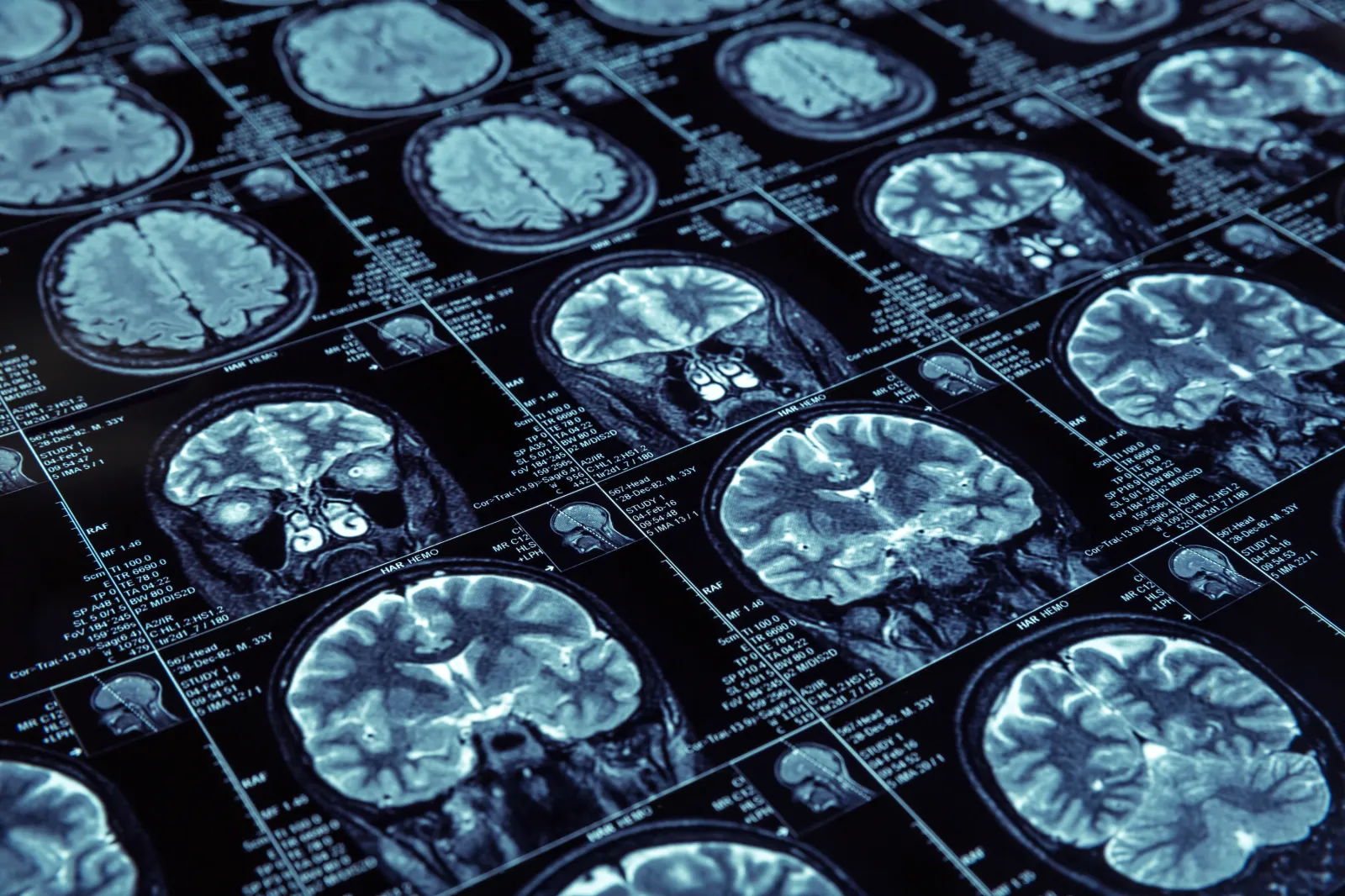 Three Gene Variants May Delay—or Speed Up—Alzheimer’s, Study Finds