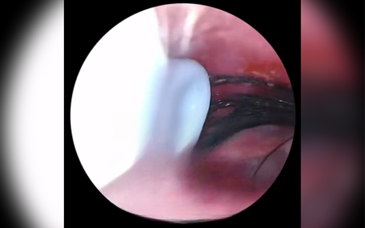 Woman Kept Complaining of Headaches, Ear Camera Reveals Unexpected Cause