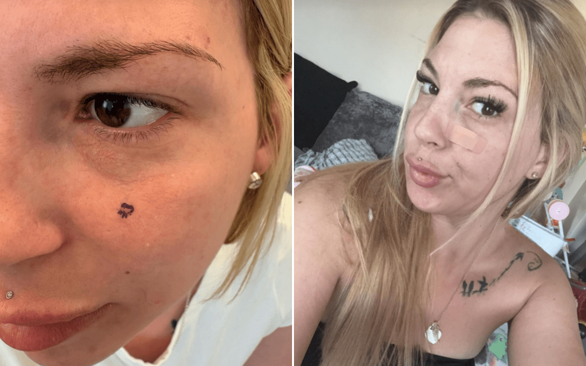 Woman Ignored Pimple on Her Face for Years&mdash;Then Scan Revealed Worst Fear