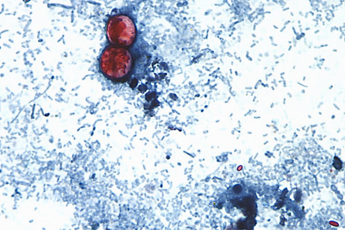Map Shows 15 States Hit By Largest Cyclospora Outbreak as Cases Surge