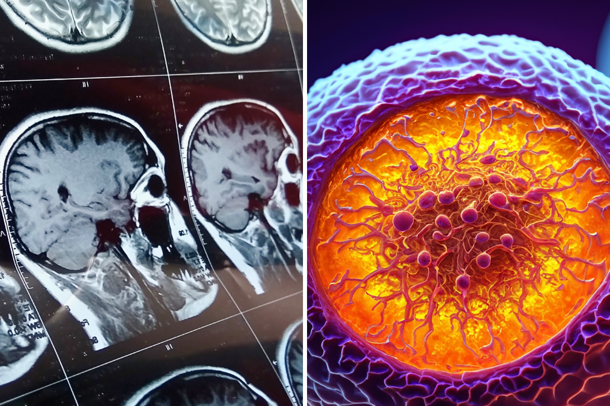 Deadly Brain Tumors May Have a Hidden Weakness—Scientists Just Found It
