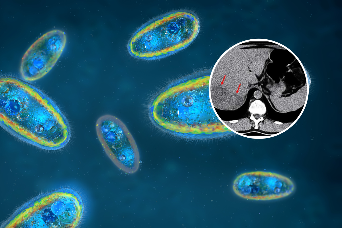 Doctors Found a Parasite Eating a Man’s Liver. Then Traced How He Got It