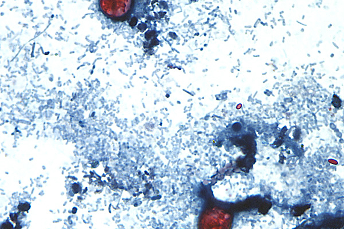 HHS Says Cyclospora Outbreak Contained: What the Data Shows