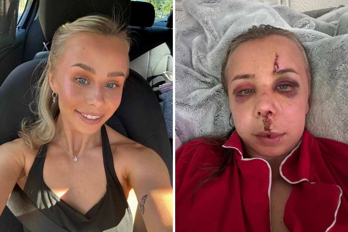 Woman Falls Down the Stairs at Home. The Aftermath Changes Everything