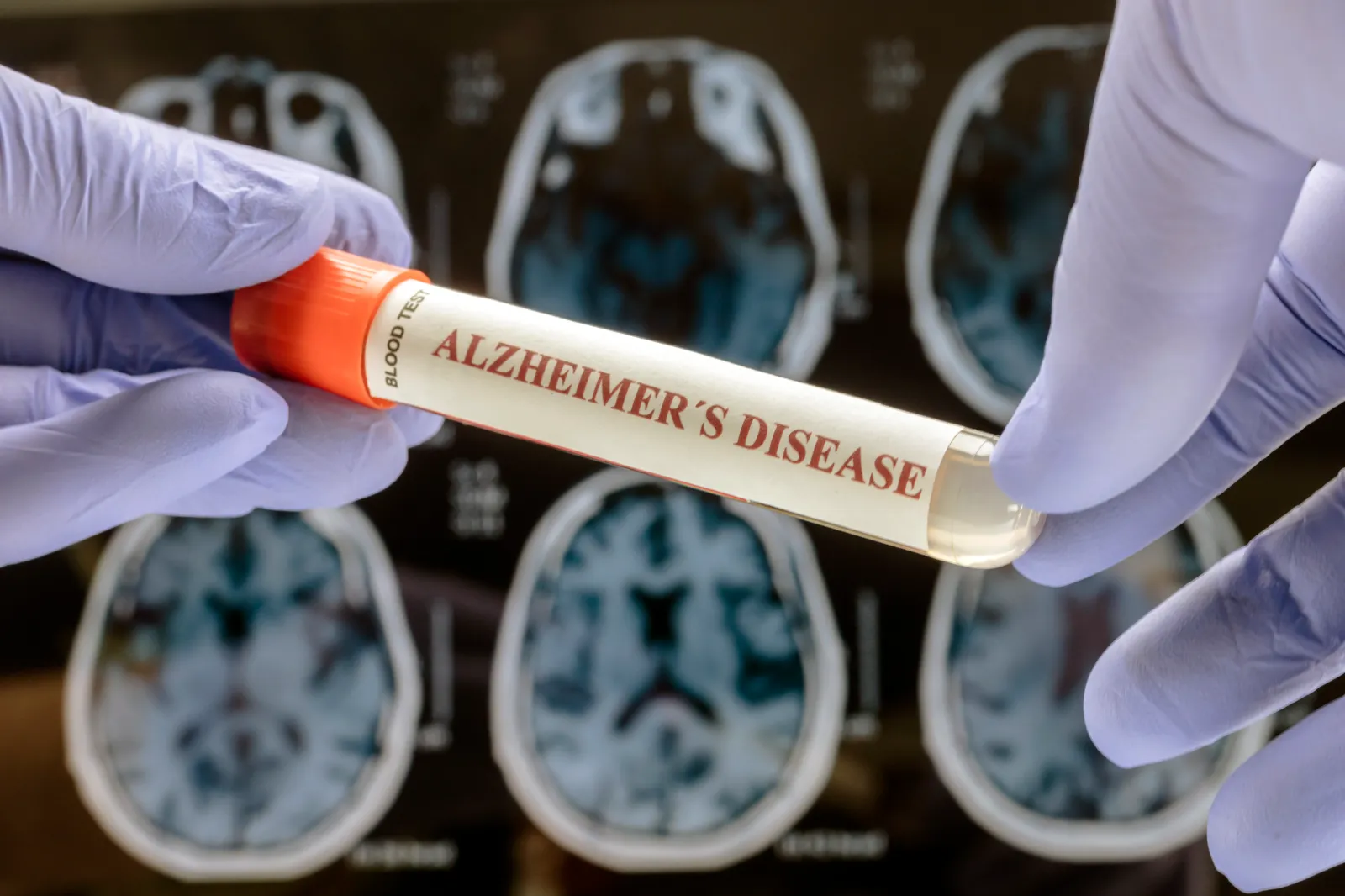 A stock image shows a scientist holding a blood sample to investigate remedy against Alzheimer's disease.
