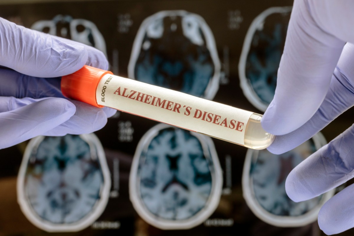 Overlooked Body Function May Predict Faster Alzheimer& 039;s, Study Finds Overlooked Body Function May Predict Faster Alzheimer& 039;s, Study Finds