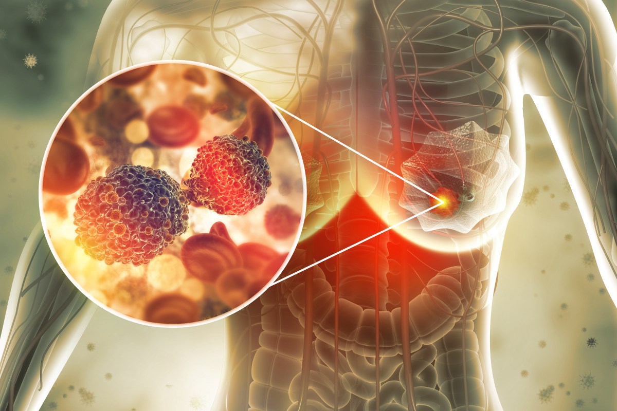 Researchers Test New Way To Treat Breast Cancer—and It’s Not Chemotherapy