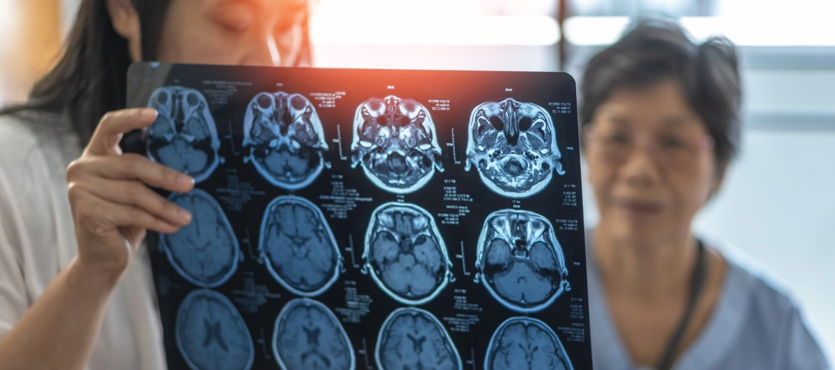 Estrogen Therapy May Hold Clues to Lower Dementia Risk in Women