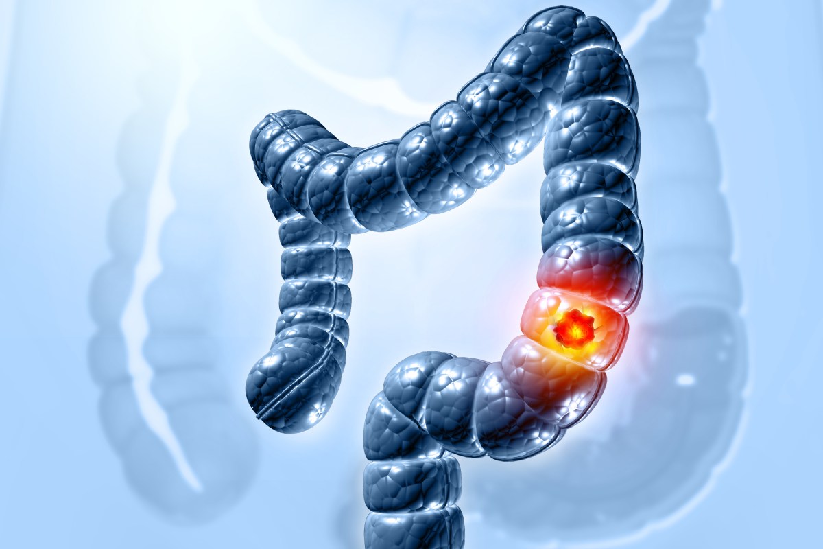 I'm a Gastroenterologist. These 3 Colon Cancer Symptoms Fool Most People