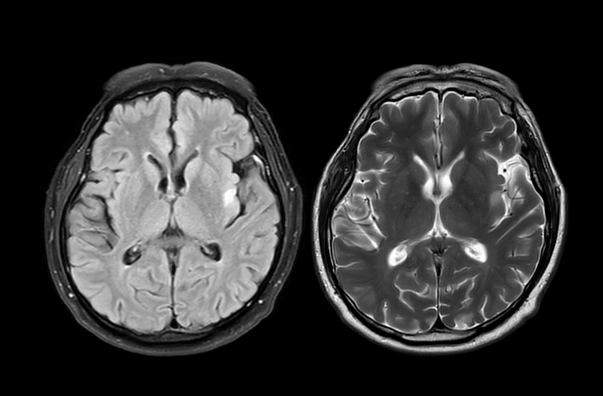 Brain Shrinkage Could Act as a 'Timer' for Early-Onset Dementia