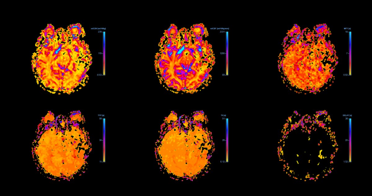 Drug Taken for Common Condition May Be Slowing Alzheimer’s Decline