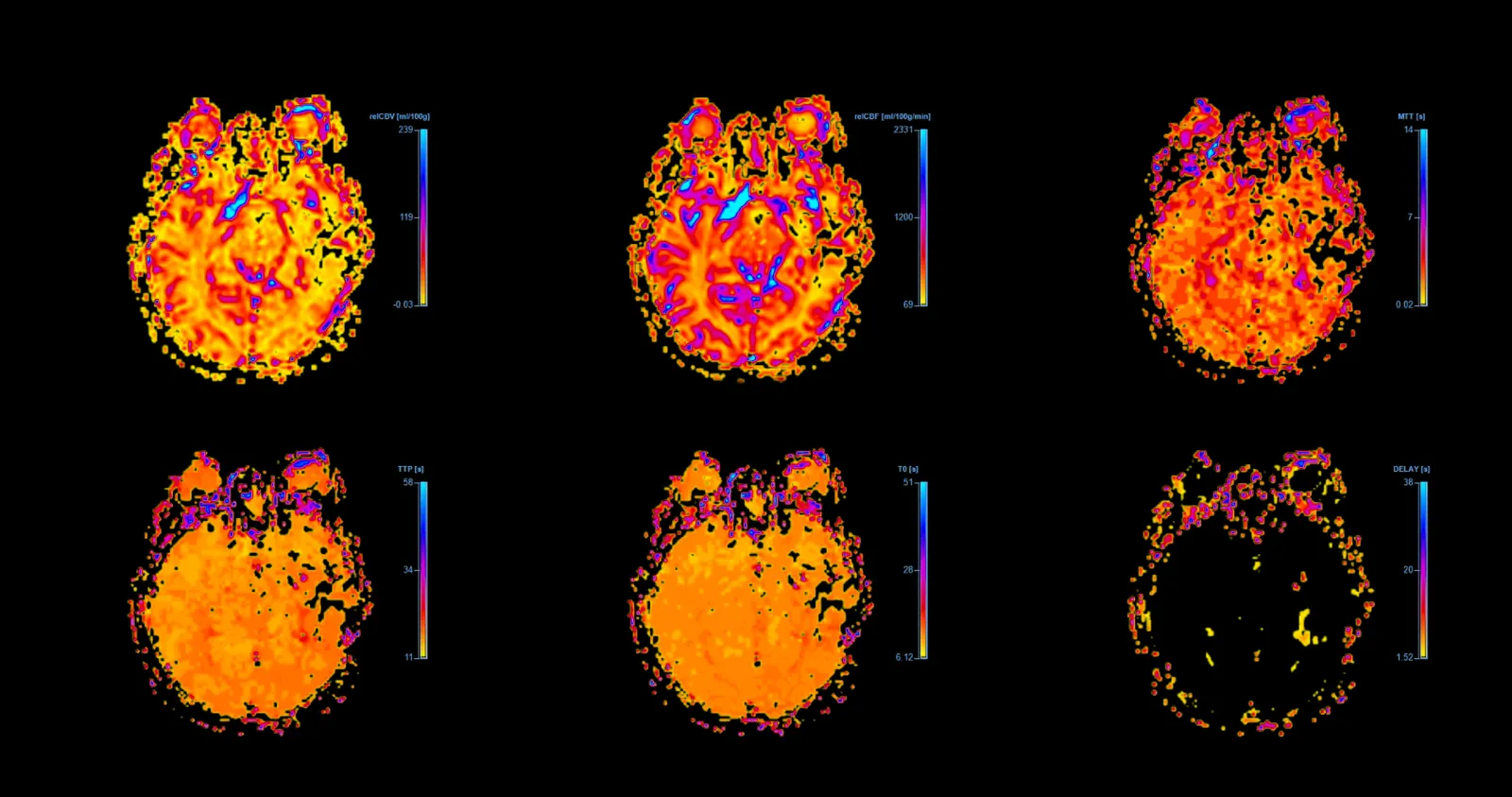 MRI brain perfusion imaging showing cerebral blood flow and tissue viability.