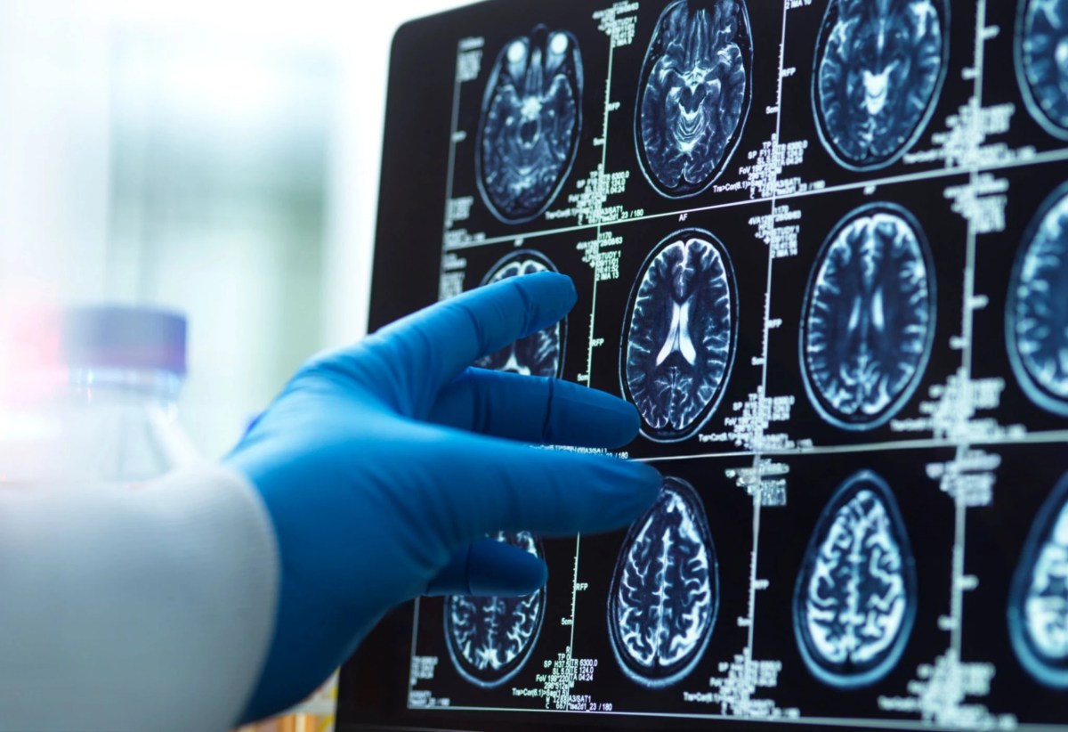 Scientists Find Hidden Alzheimer's Brain Buildups That May Appear Early