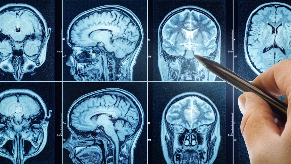 Common Health Risks You Can Change May Be Accelerating Dementia—Study Finds
