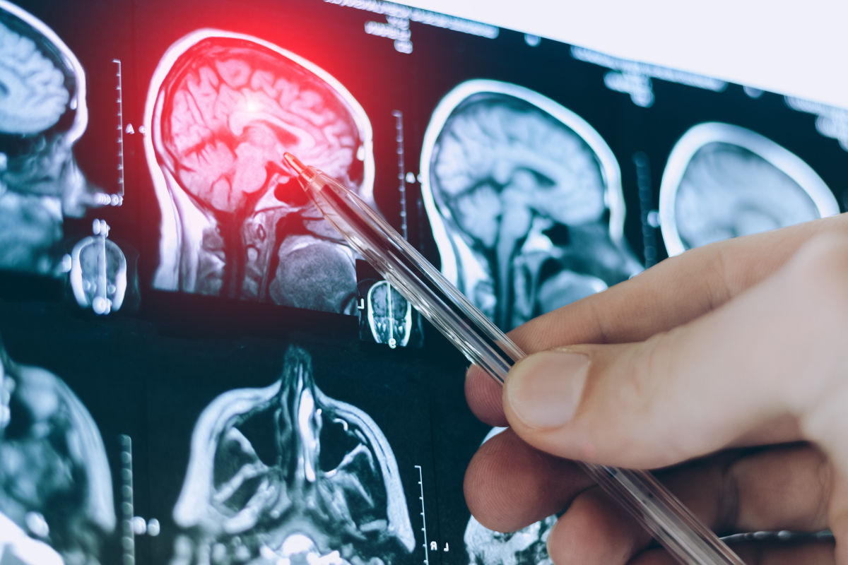 Alzheimer's Blood Tests Have a Blind Spot. Scientists May Have Found a Fix