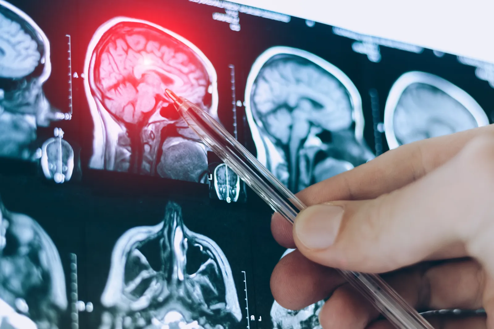 Alzheimer’s Blood Tests Have a Blind Spot. Scientists May Have Found a Fix
