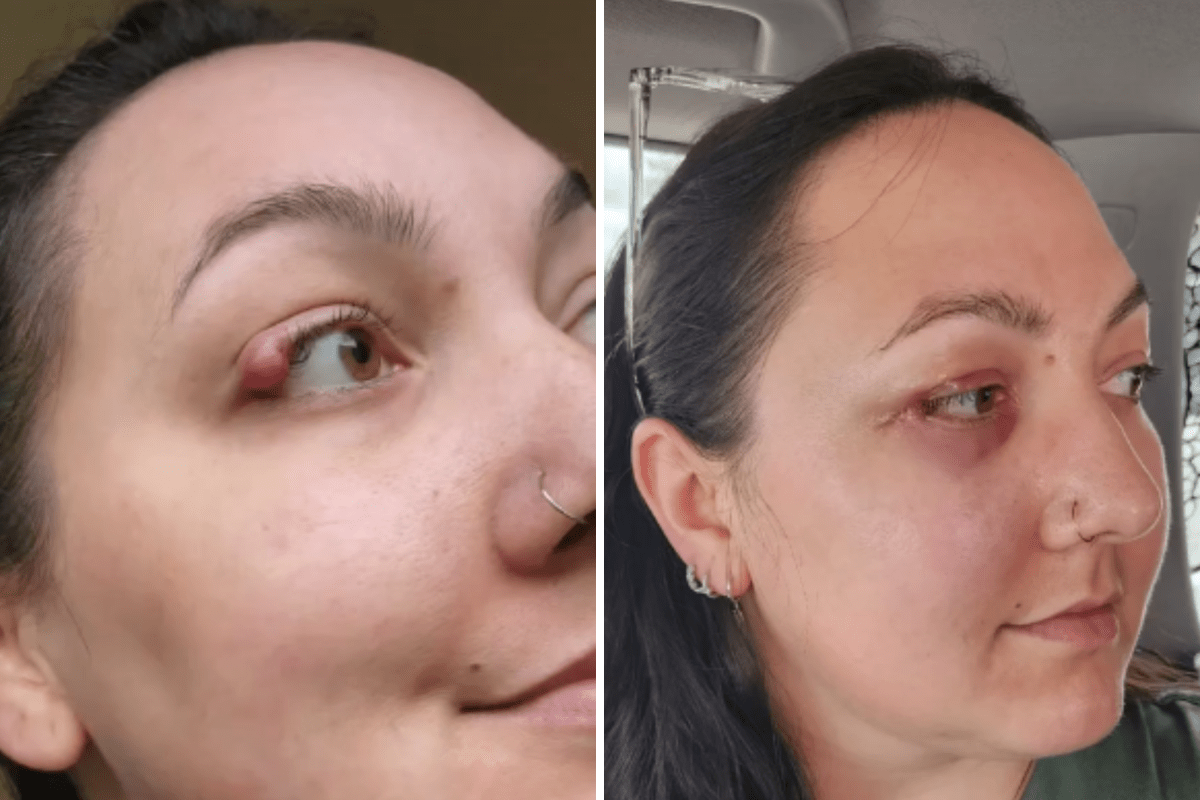 I Thought I Had a Stye in My Eye—Nothing Prepared Me for the Horrific Truth