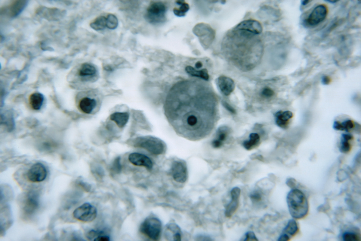 North Carolina Teen Dies From Brain-Eating Amoeba: How To Protect Yourself
