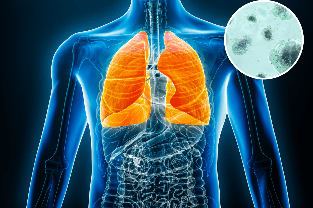 Scientists Studied Lung Cancer Patients—A Troubling Pattern Emerged