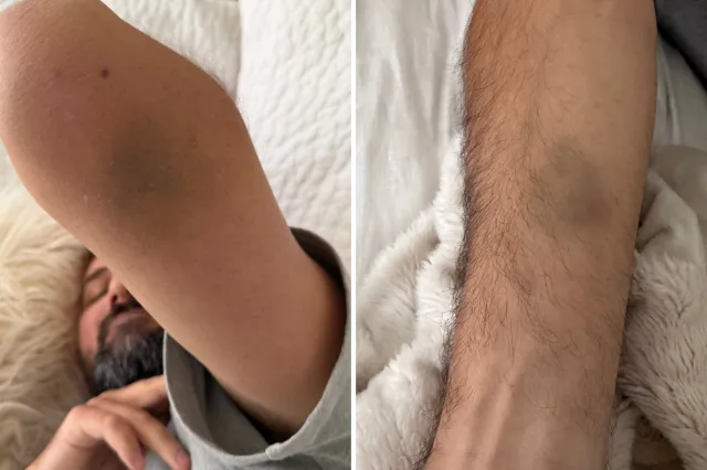 The bruises on Reese Willard's arms.
