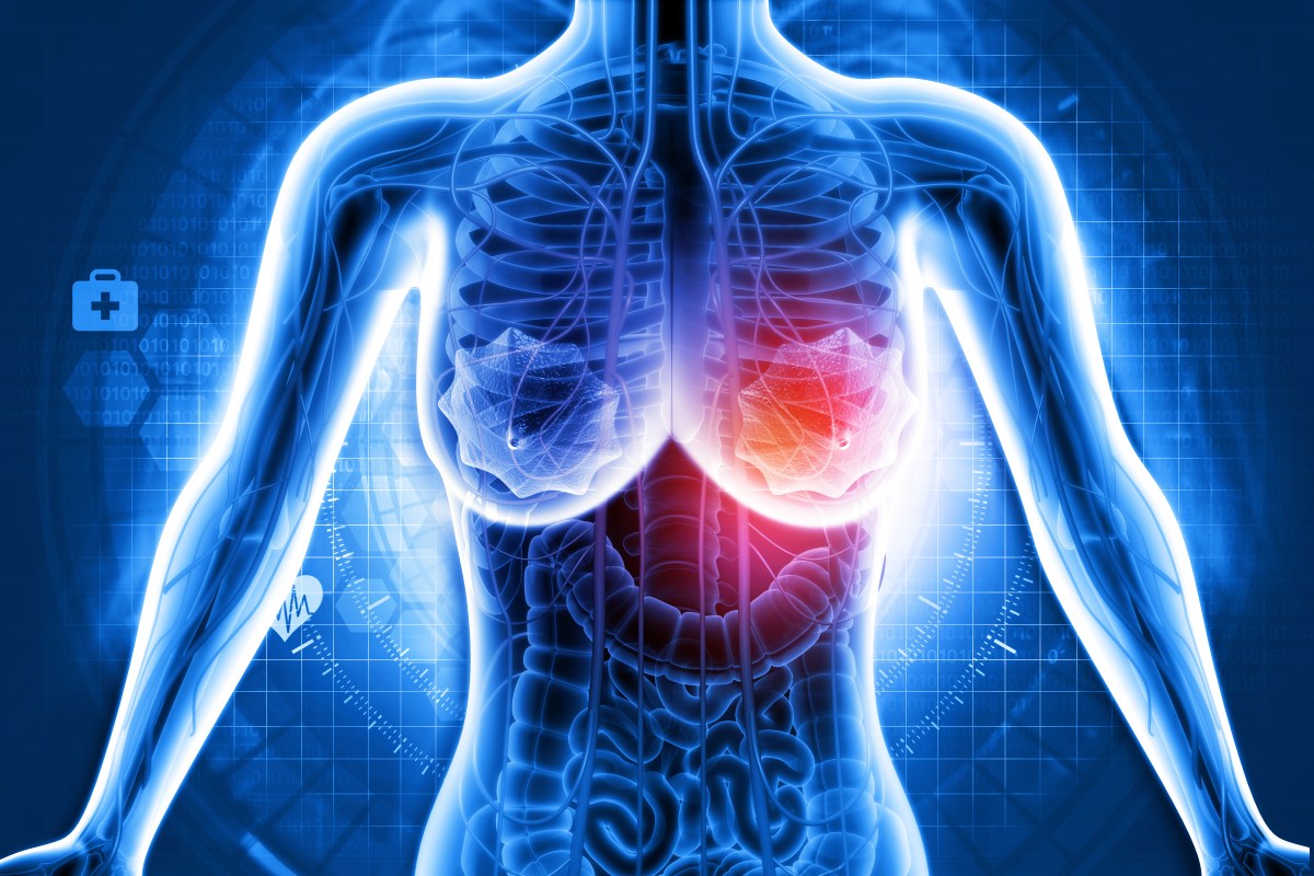 Aggressive Breast Cancer Has a New Weakness, Study Finds