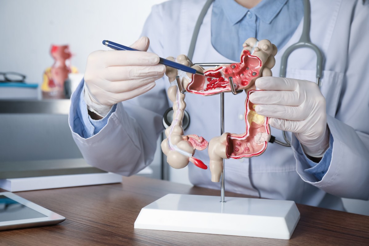 Major Study Finds Key Difference in Bowel Cancer Before 50