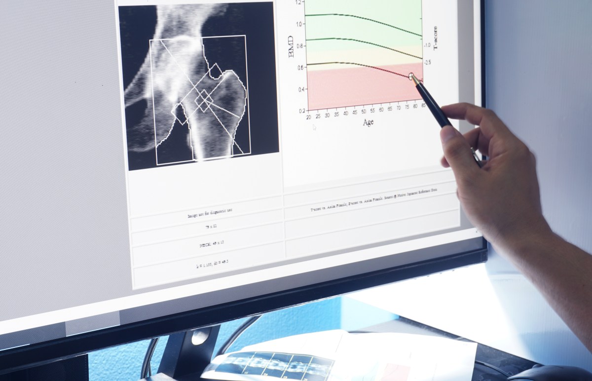 Routine Scan Millions Already Get May Hold Clues to Future Brain Decline