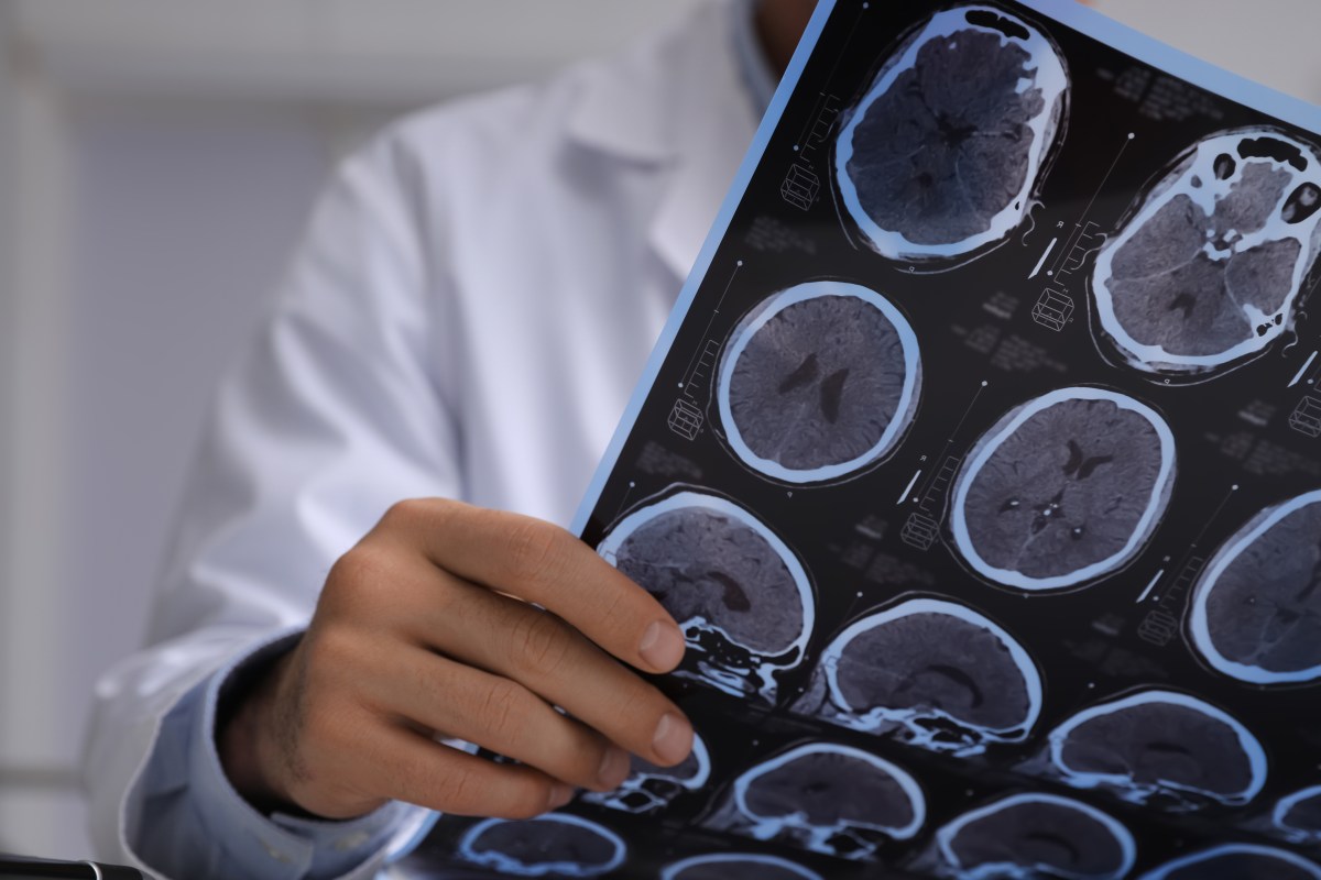 Alzheimer's May Begin 7 Years Before Brain Scans Detect It
