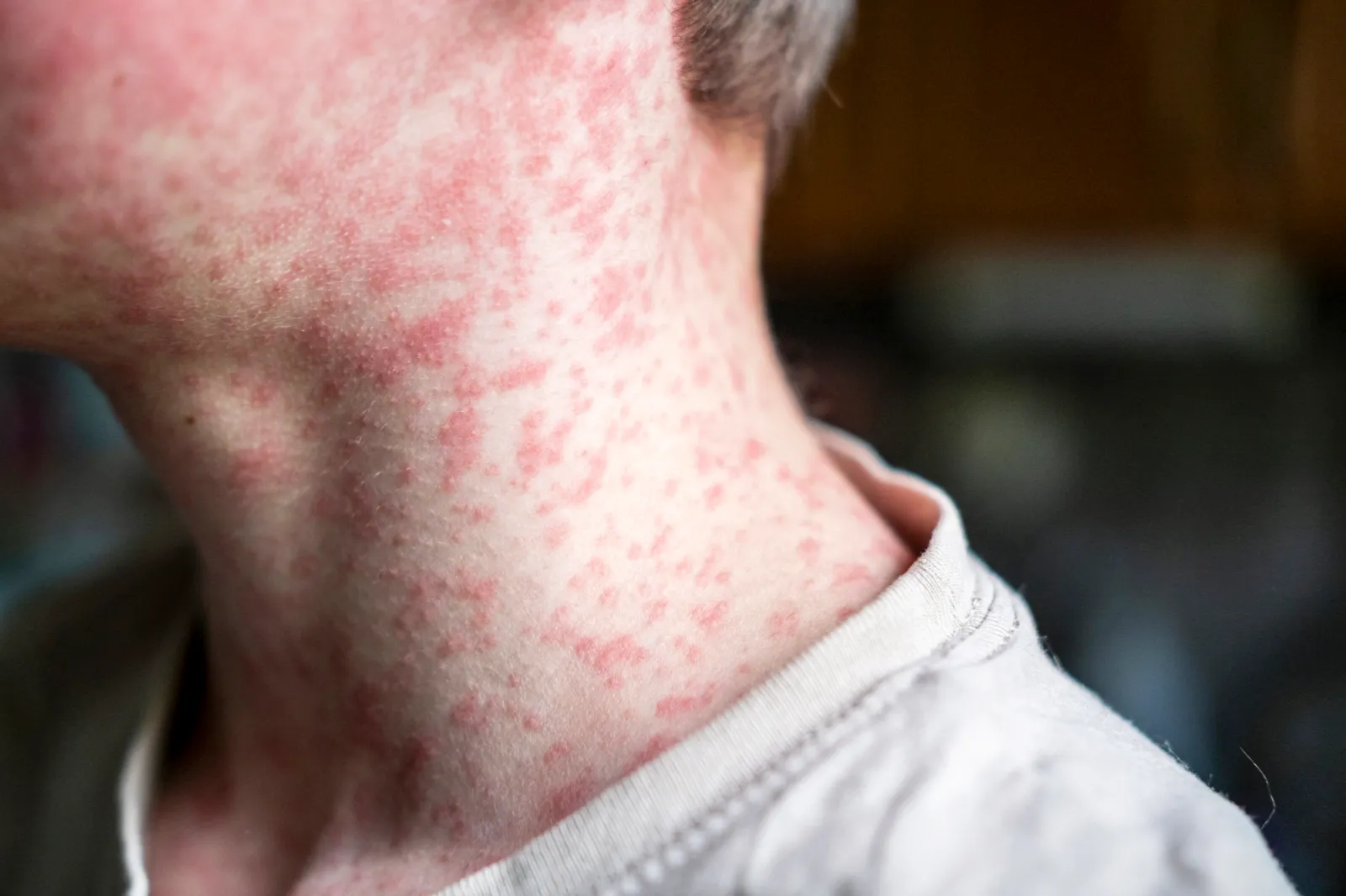 Measles Resurgences: A Global Health Concern Amidst Vaccination Declines