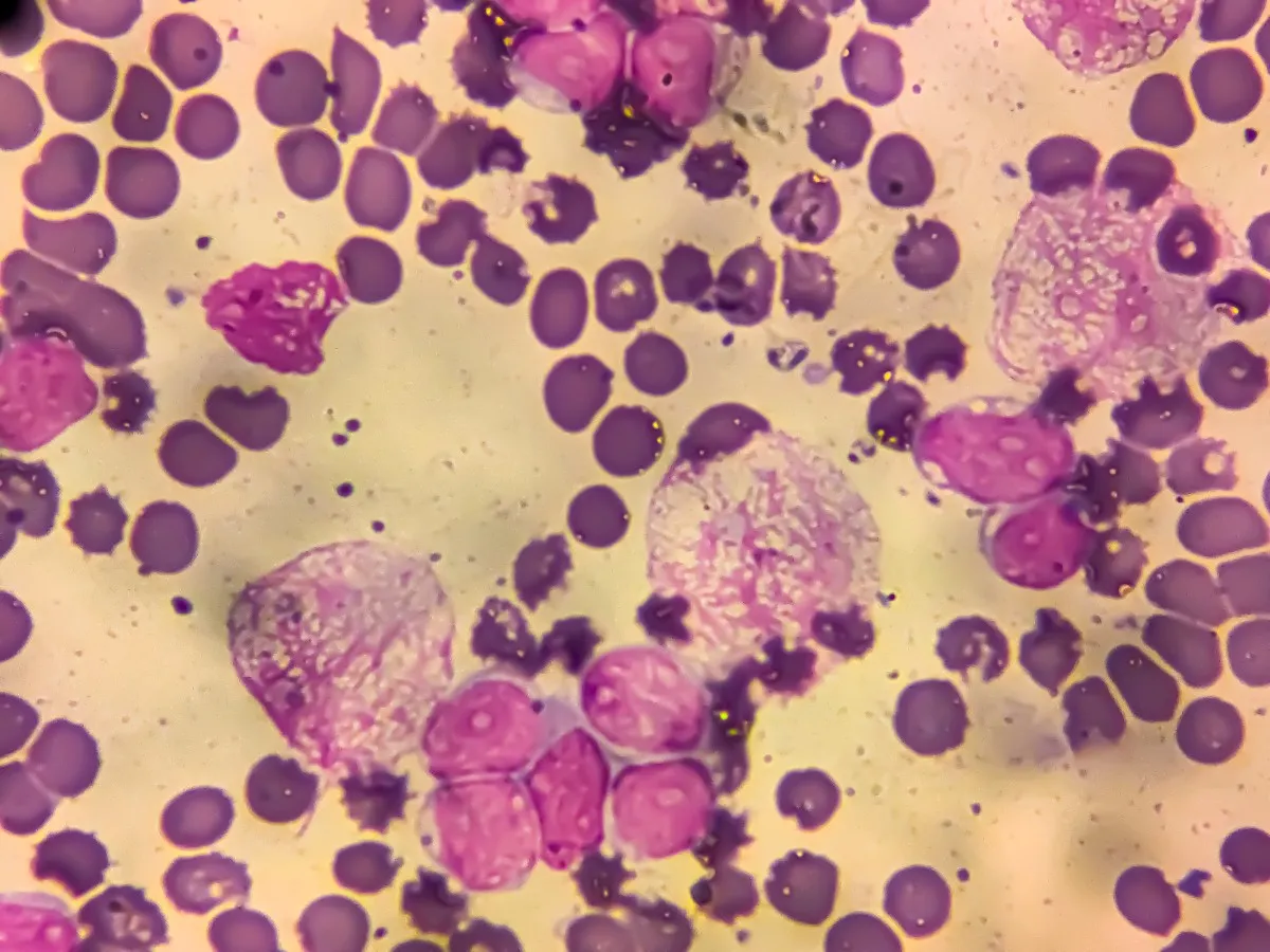 1 in 8 cancer cases worldwide linked to infections, study finds 1 Chronic myeloid leukemia cells can be seen in the blood under a microscope.