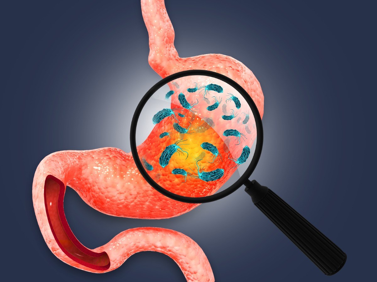 Common Stomach Bacteria Linked to Colorectal Cancer