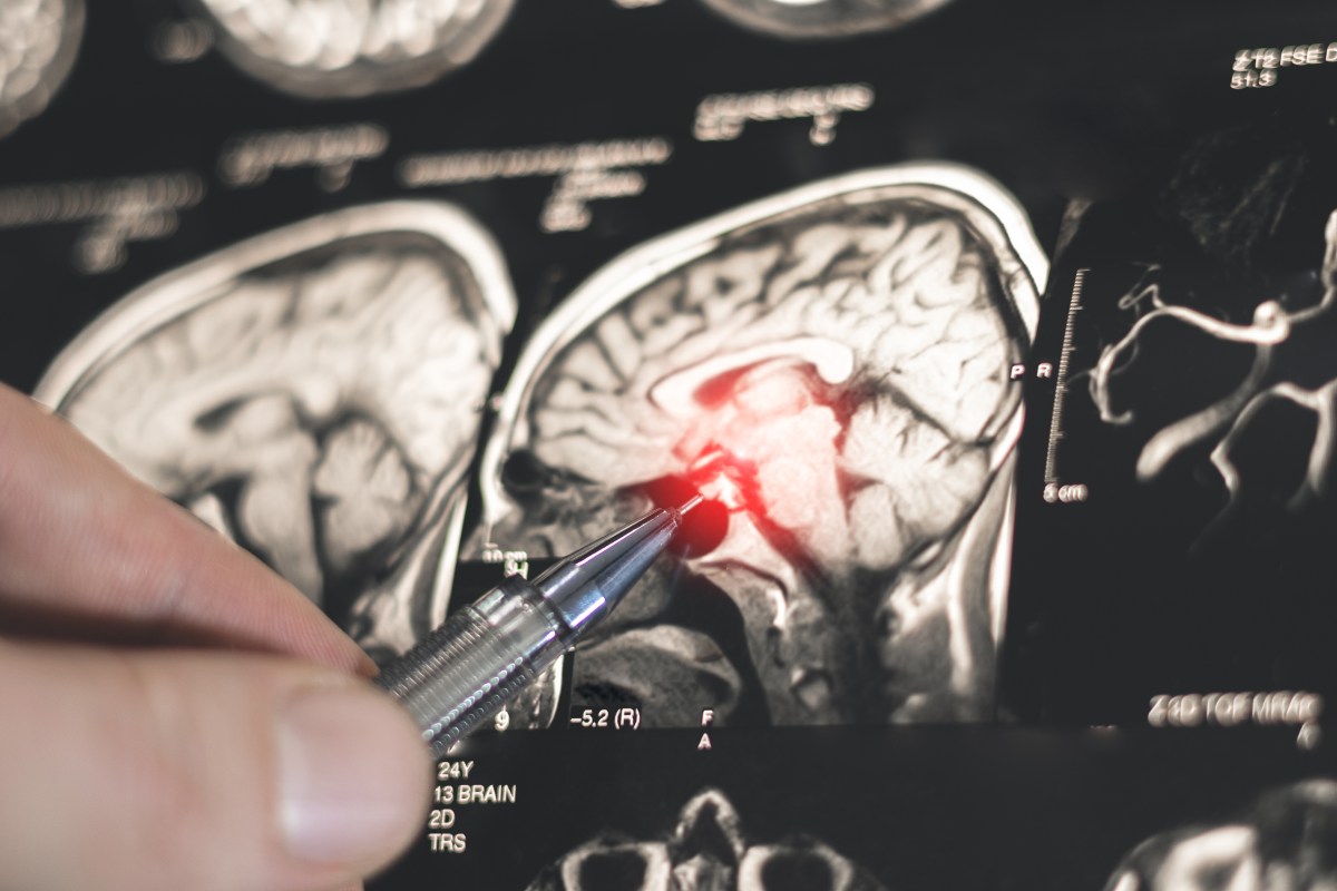 Blood Pressure Treatment Linked to Lower Dementia Risk, Study Finds