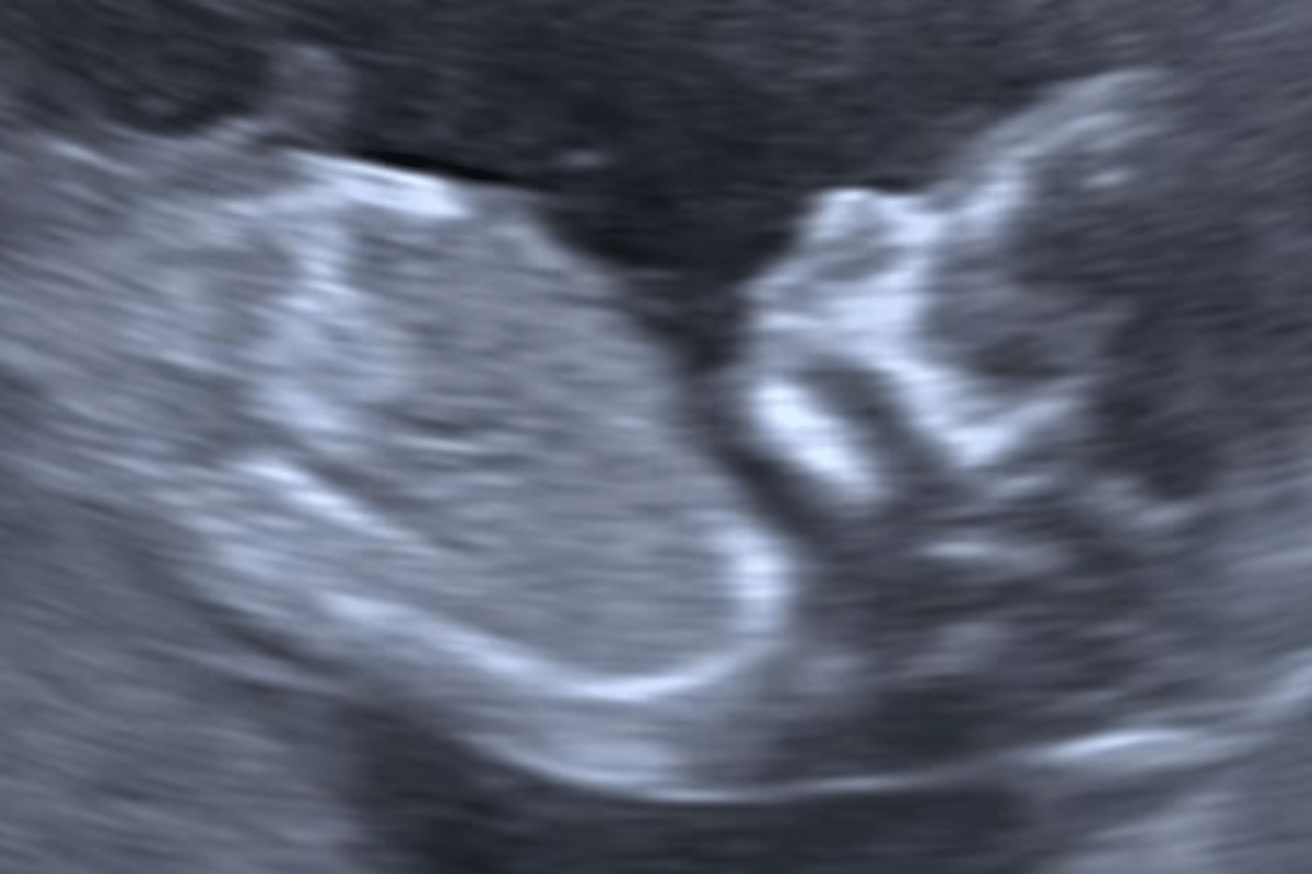 Woman Offered Termination After 20-Week Scan, Stunned by What Happens Next