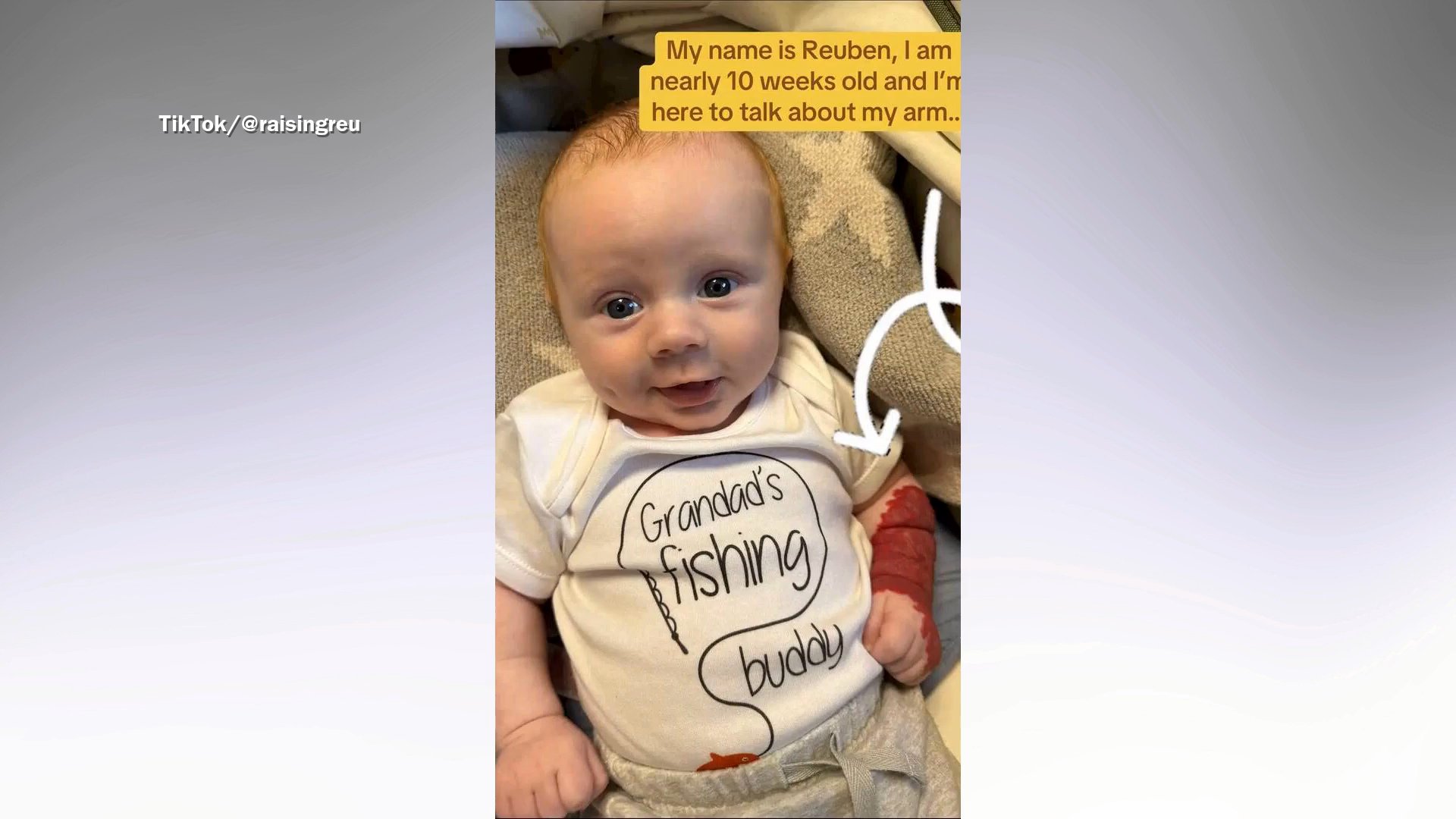 Parents Told Newborn’s Purple Arm Mark Was Bruising. Then Came the ...