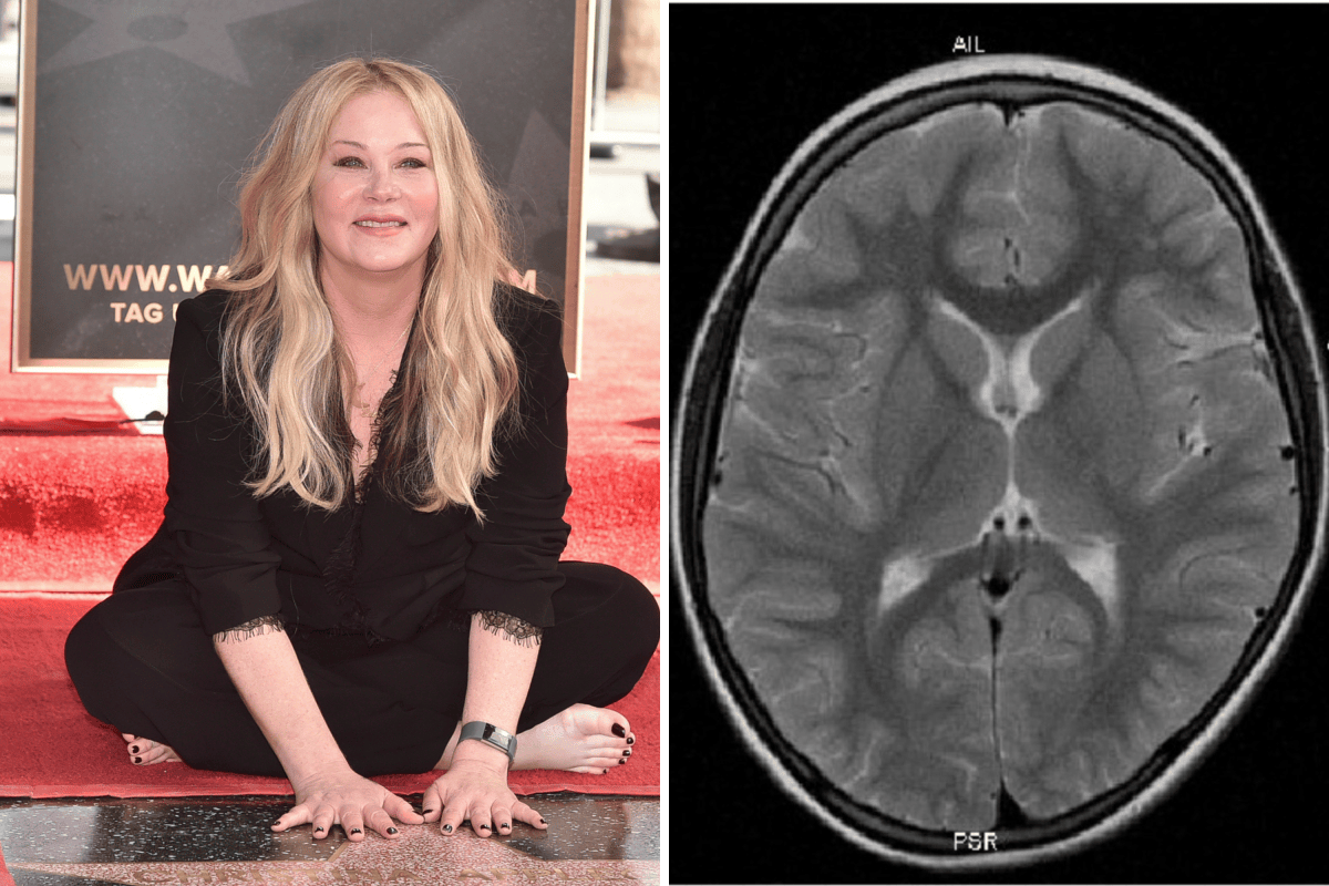 MS Symptoms Explained as Christina Applegate Shares Misdiagnosis