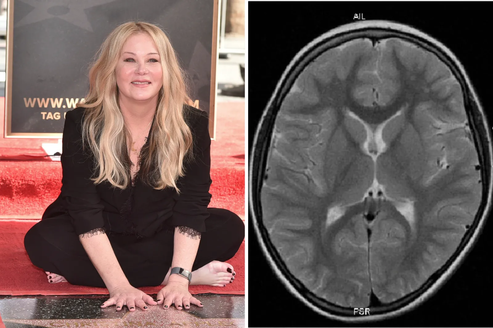 Christina Applegate, left, poses at a ceremony honoring her with a star on the Hollywood Walk of Fame in Los Angeles on November 14, 2022. An image, right, shows an MRI scan taken March 7, 2018, at Campus Clinic Gynaecology at the Ruhr-University Bochum.