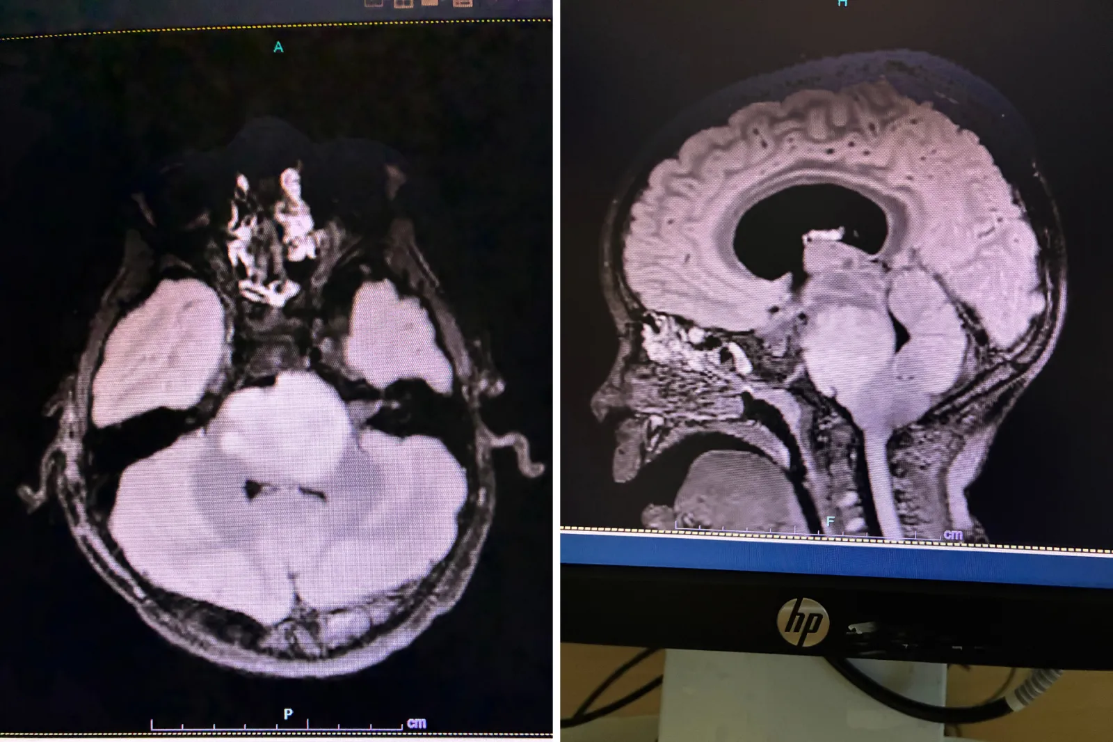 A scan showing the tumor in Townes' brainstem.