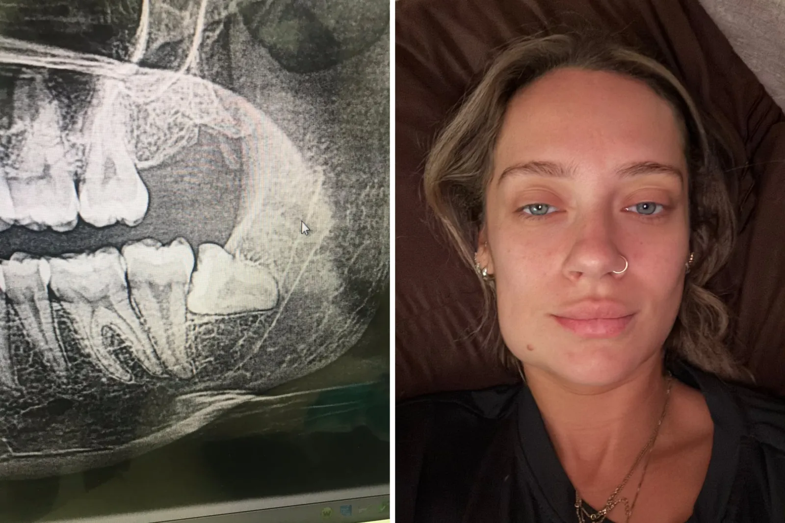 An X-ray scan of Sara Dick's wisdom tooth prior to removal and Dick's face after the procedure.