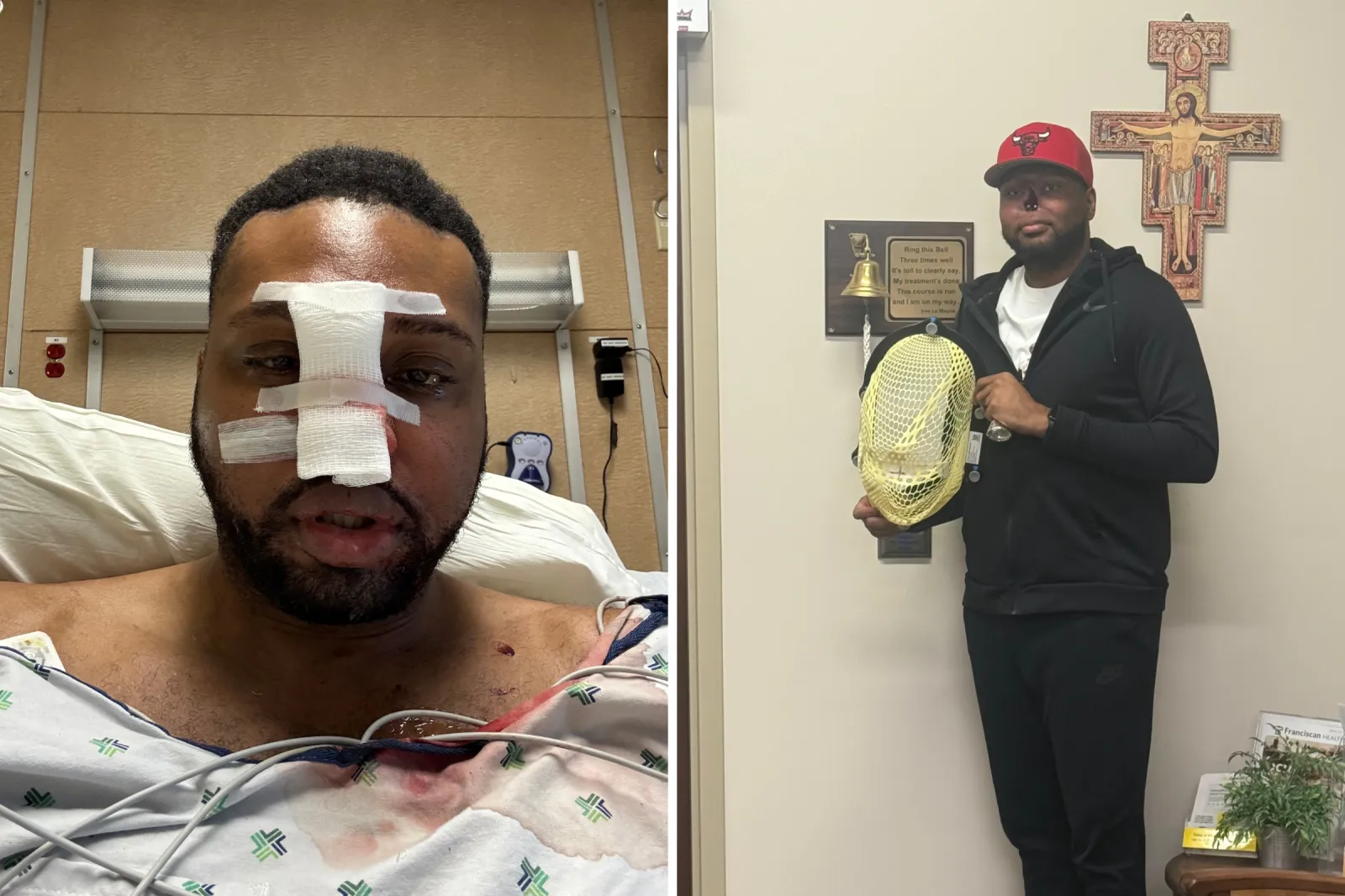 From left: Dr. Alfred Dewayne Sutton after surgery and holding his radiation mask.