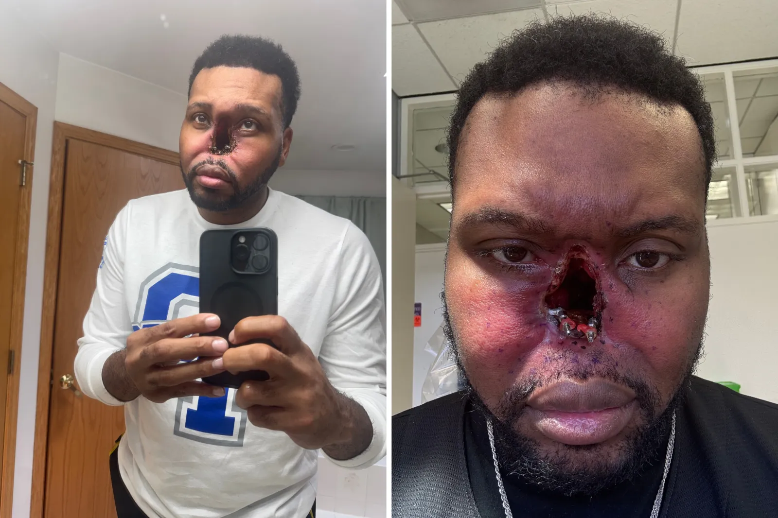 Dr. Alfred Dewayne Sutton taking a selfie after undergoing a total rhinectomy.