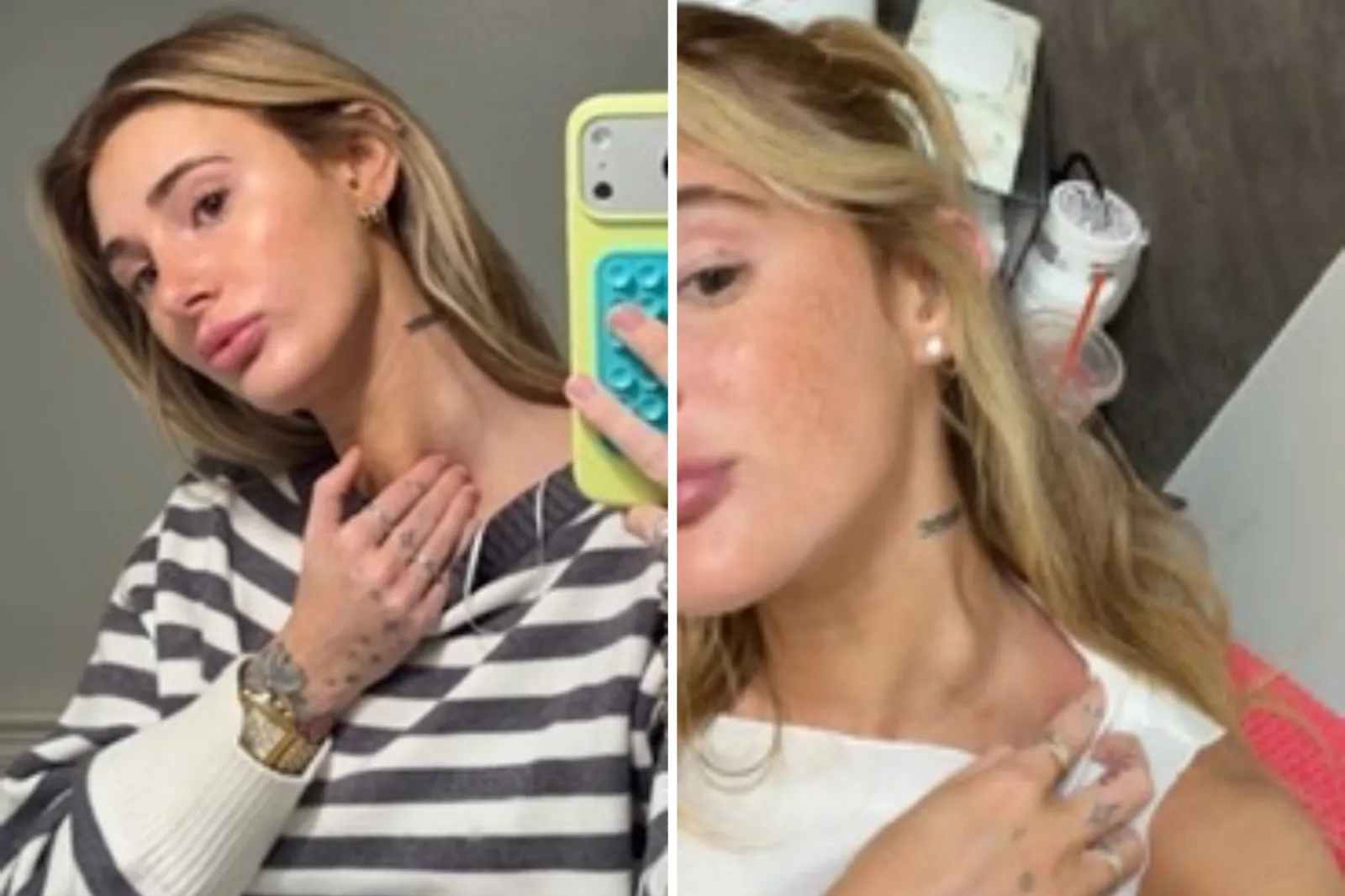 From left: Sarah Esposito the day the lump formed in February 2026, and in June 2026.
