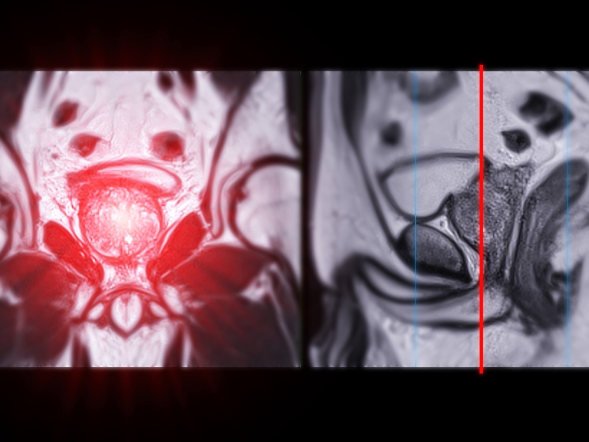 Scientists May Have Found How Aggressive Prostate Cancer Resists Treatment